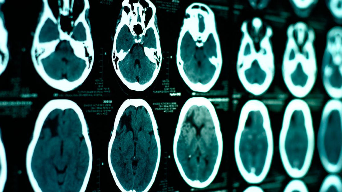 La importancia de un diagnóstico temprano en pacientes con parálisis cerebral