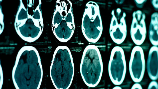 La importancia de un diagnóstico temprano en pacientes con parálisis cerebral