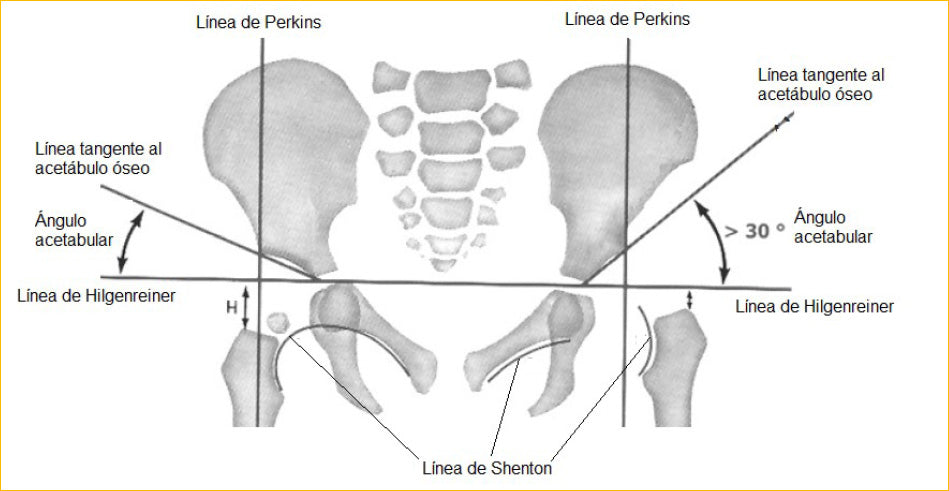 Grados de displasia de cadera y qué significa cada uno