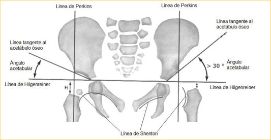 Grados de displasia de cadera y qué significa cada uno