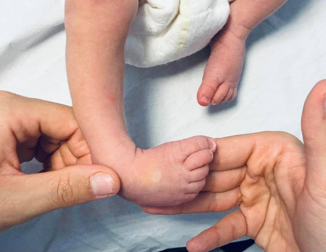 ¿Qué es el pie equinovaro y cómo afecta a los bebés?